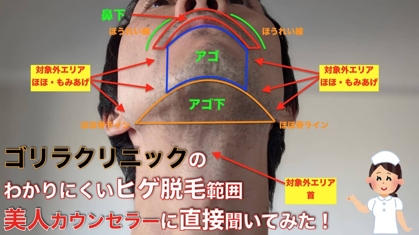 【画像で解説】ゴリラクリニックのヒゲ脱毛完了コースってどこまでが範囲なの？【カウンセラーに直接聞いた】サムネイル画像