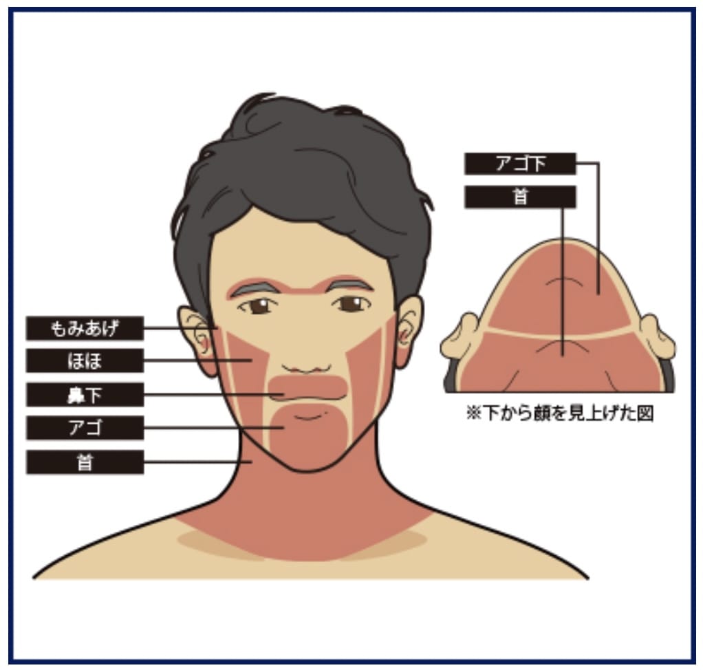 ゴリラクリニックのヒゲ脱毛レーザー照射範囲のイラスト