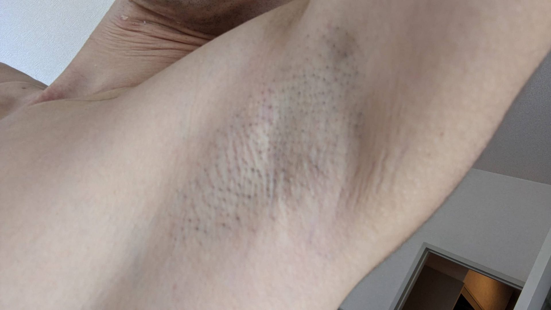 ワキ脱毛１回目直後の肌の様子