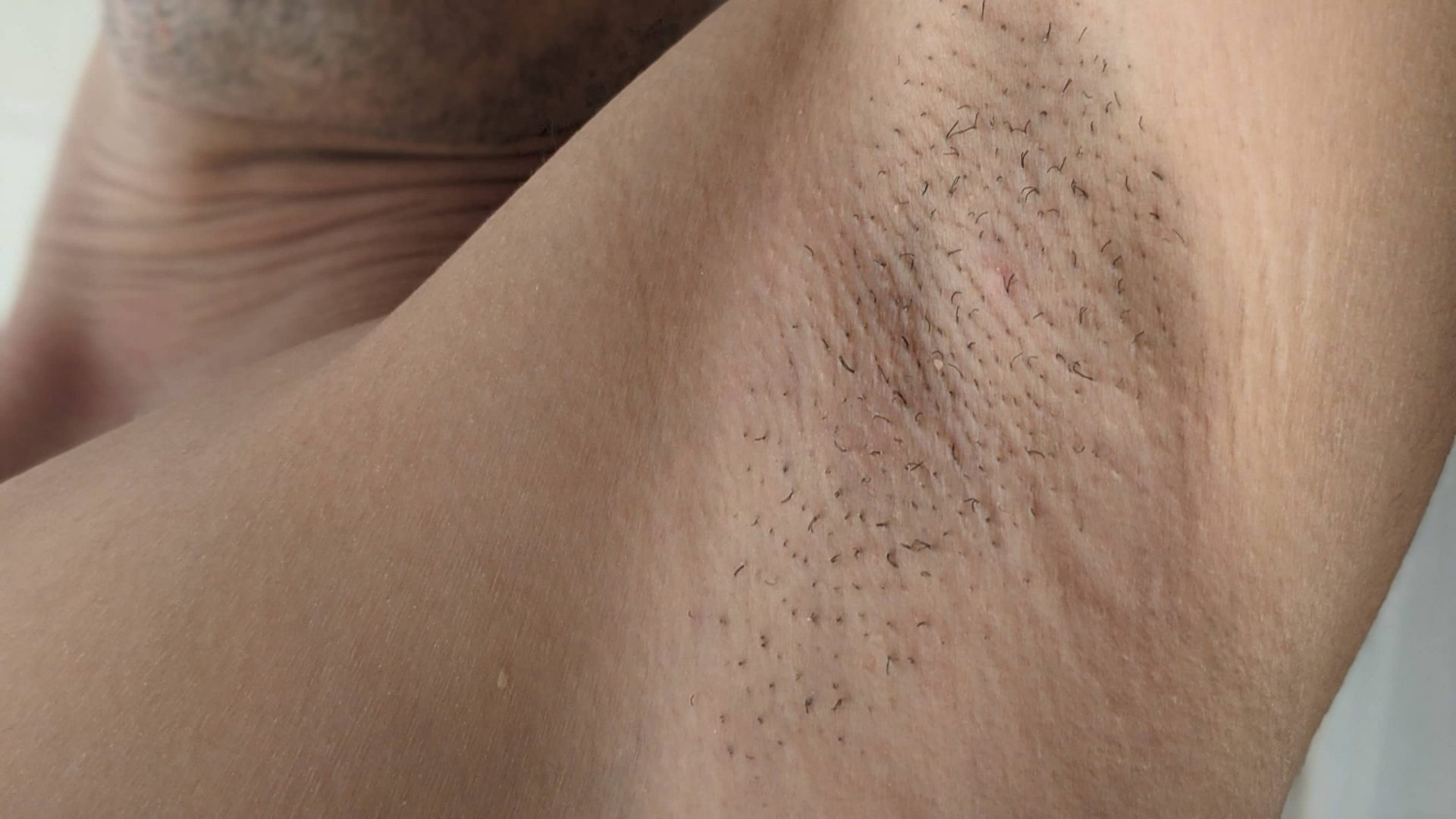 ワキ脱毛から１週間後。ポロ期到来