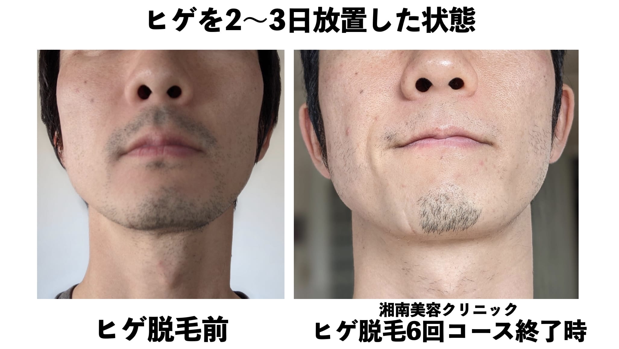 ヒゲを2〜3日放置した状態での比較（顔正面）湘南美容クリニックのヒゲ脱毛の効果検証