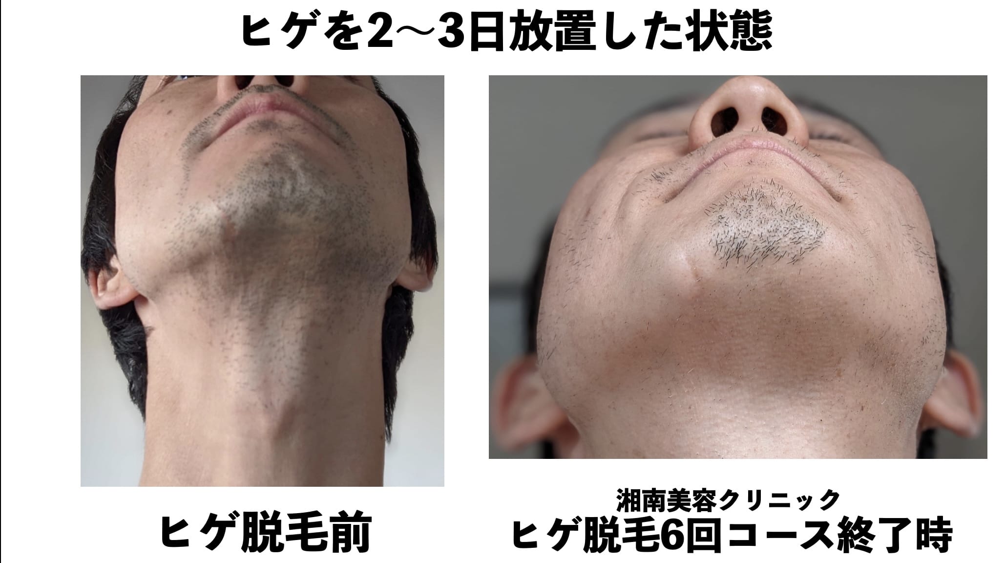 ヒゲを2〜3日放置した状態での比較（アゴ下）写真