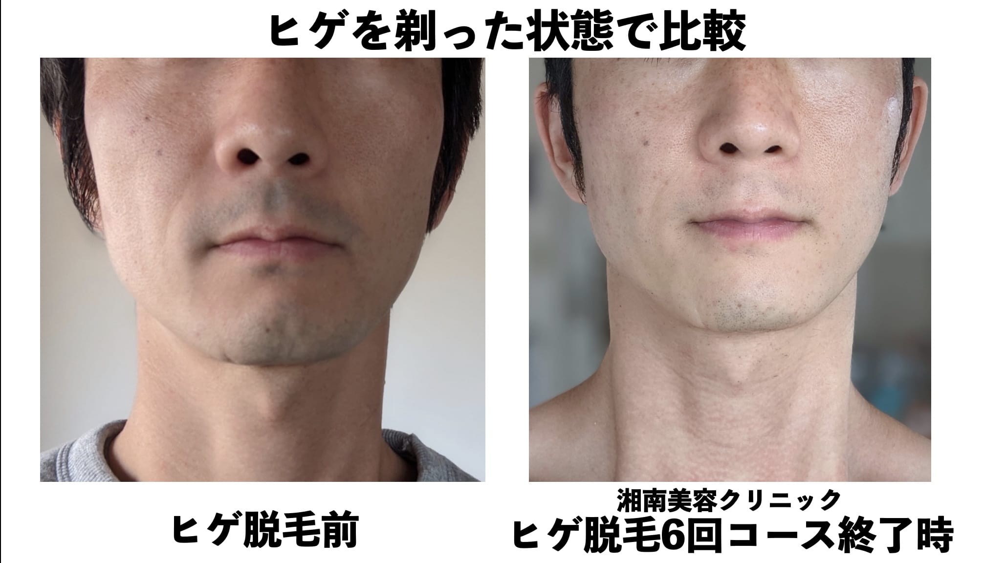 ヒゲを剃った状態での比較（口周り）湘南美容クリニックのヒゲ脱毛の効果検証