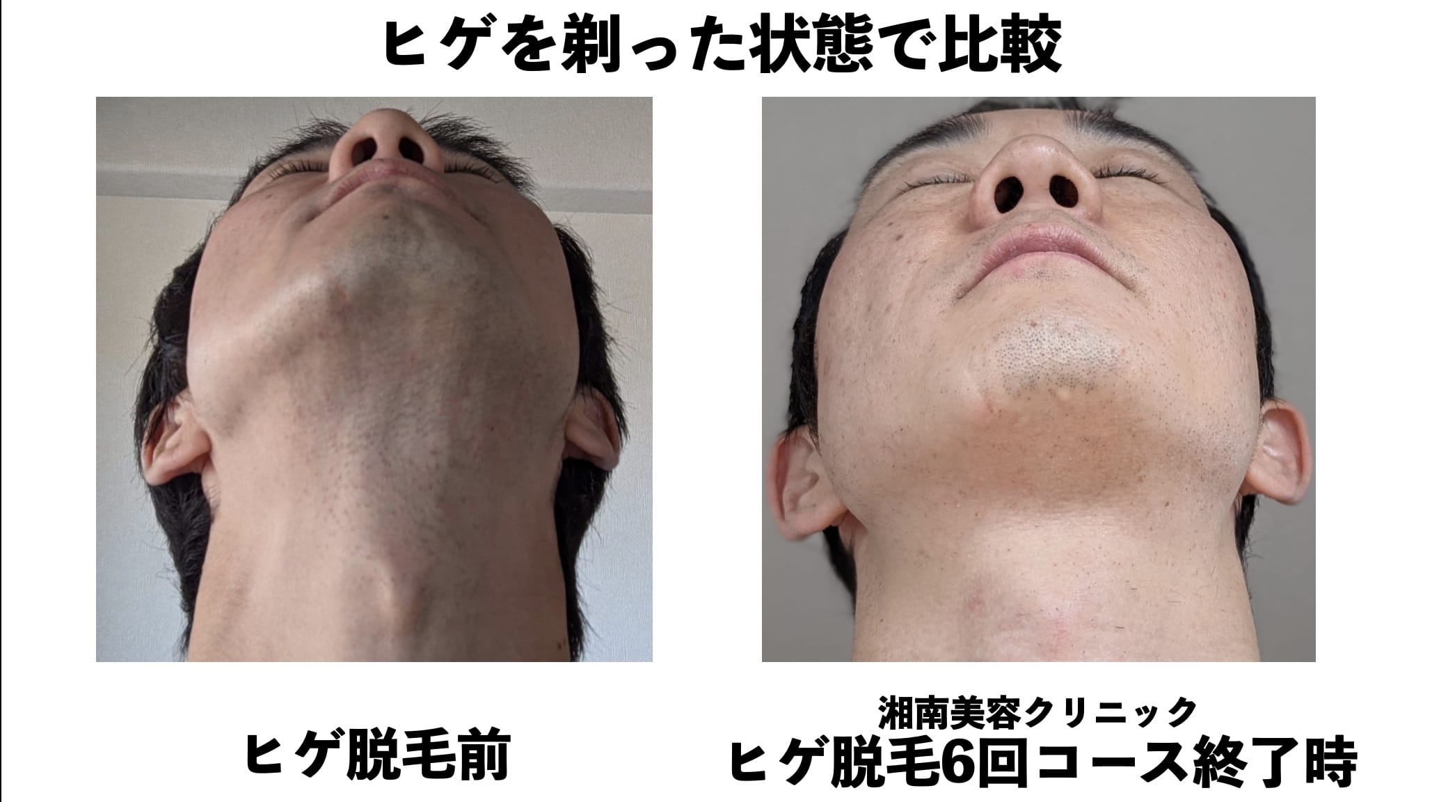 ヒゲを剃った状態での比較（アゴ・アゴ下）湘南美容クリニックのヒゲ脱毛の効果検証