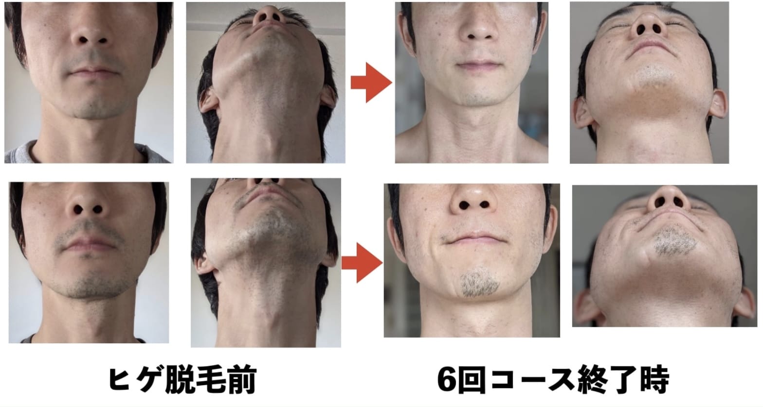 ヒゲ脱毛をして肌がキレイになった写真