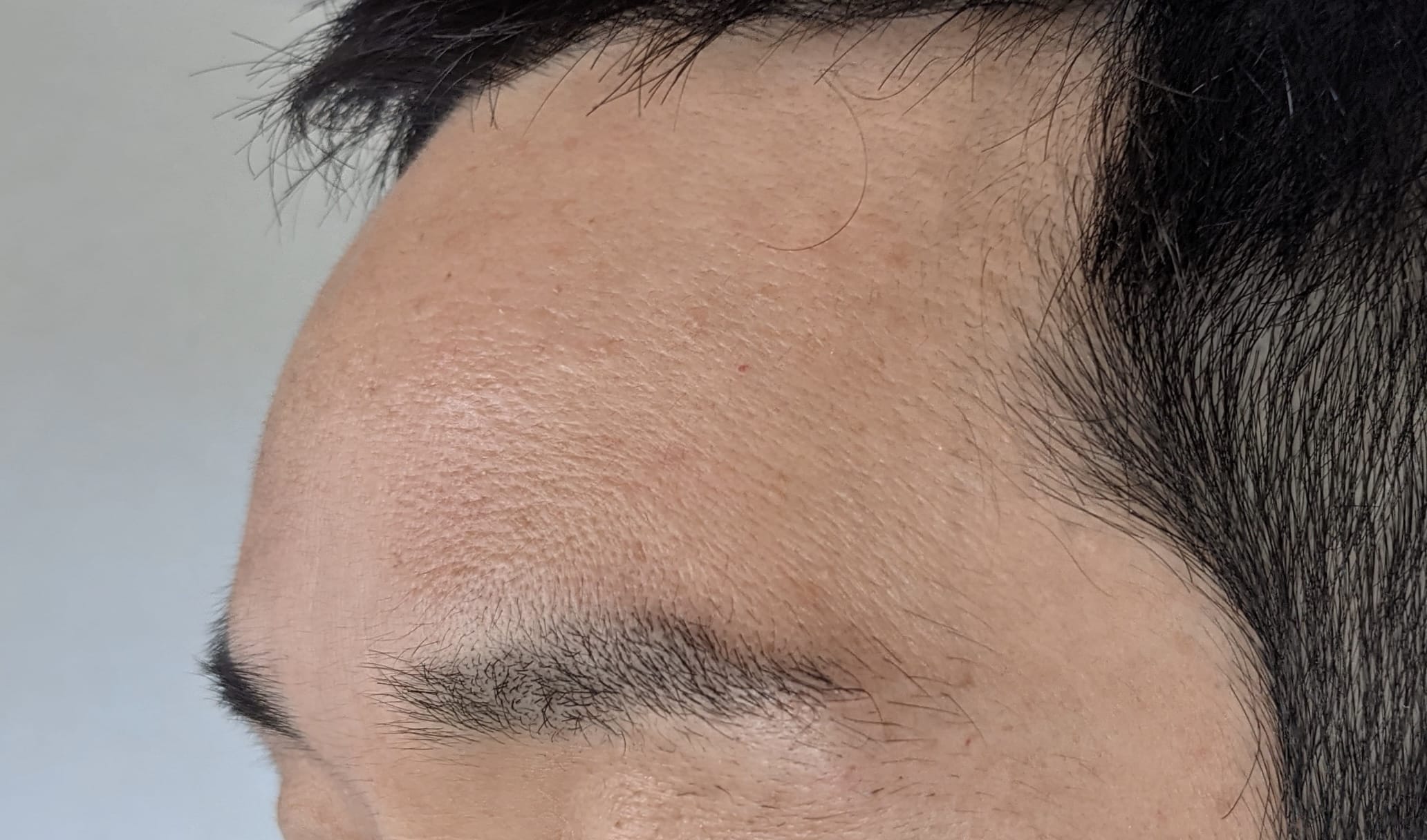 ボトックス注射2週間後のおでこの様子