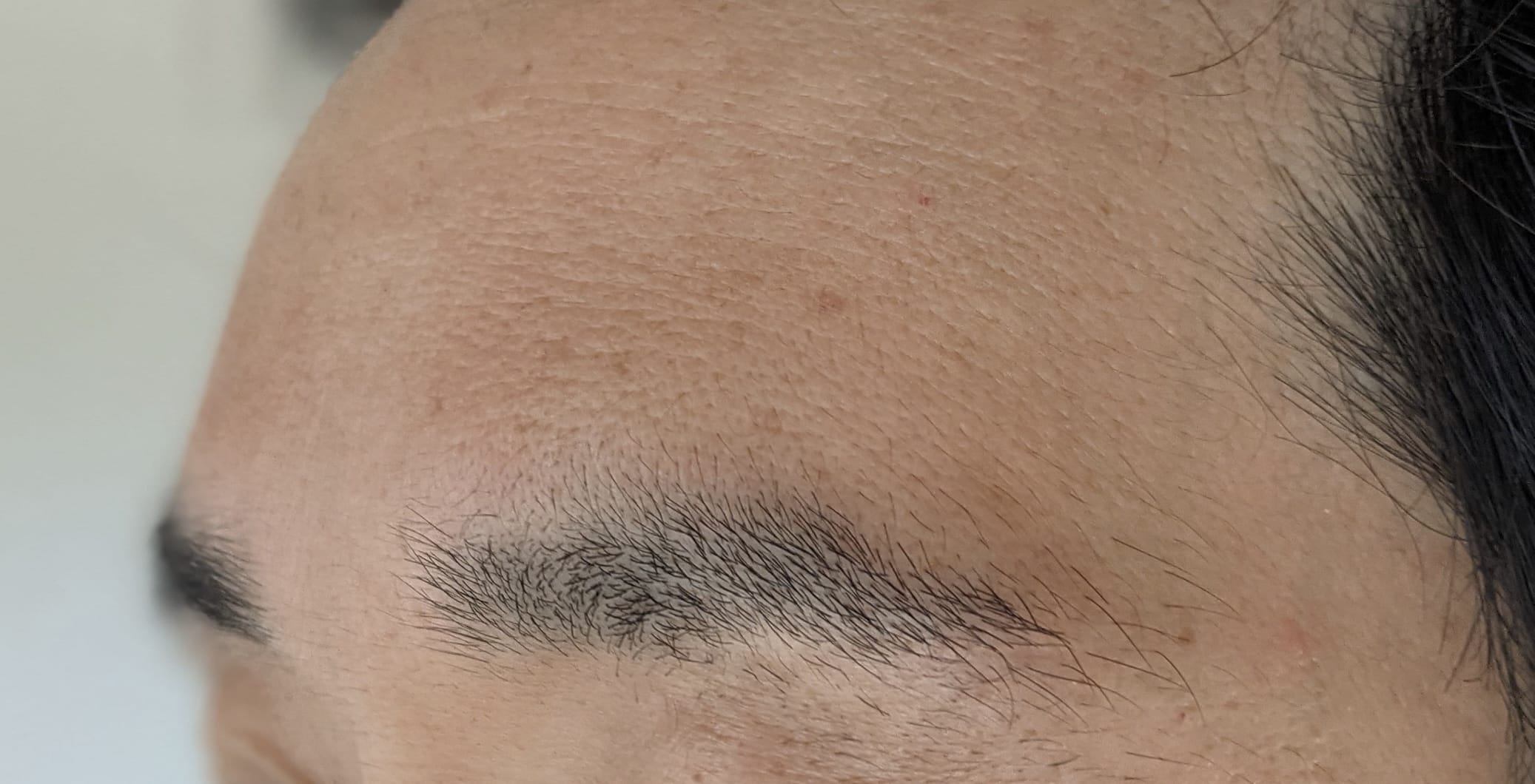 ボトックス前のおでこ（額）写真