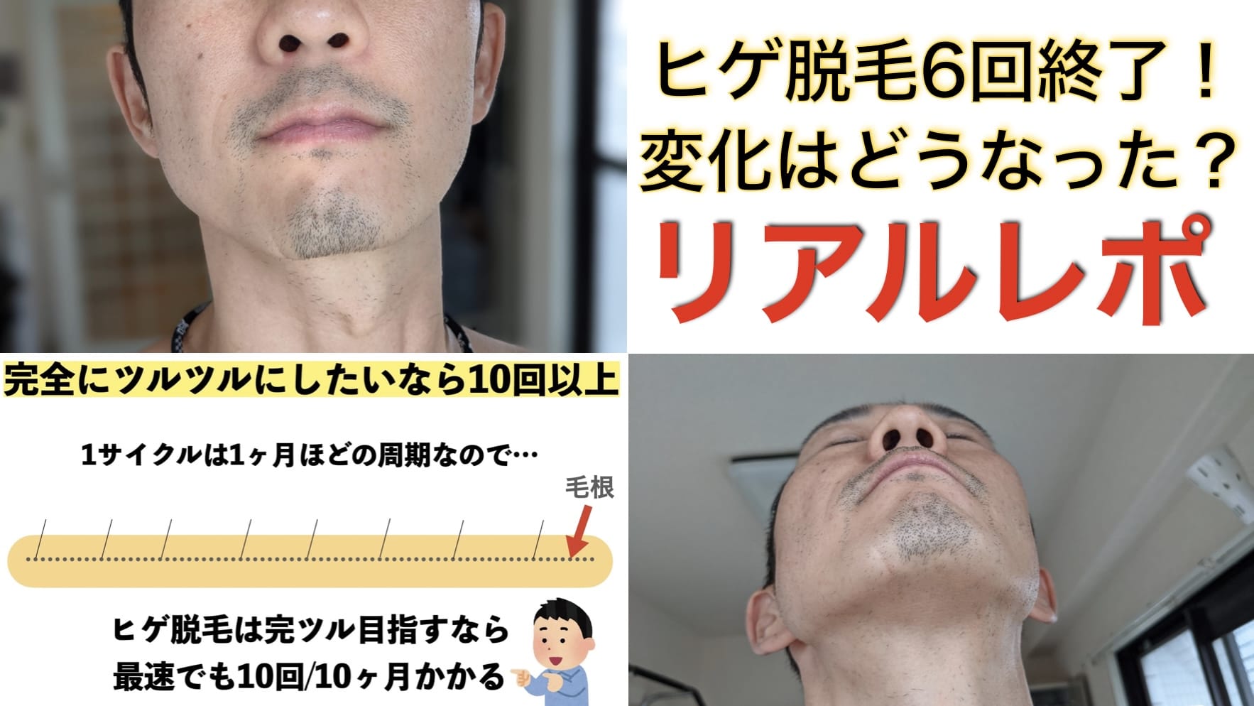 医療レーザーヒゲ脱毛6回コースだけではツルツルにならない理由とは？【リアル画像あり】サムネイル画像