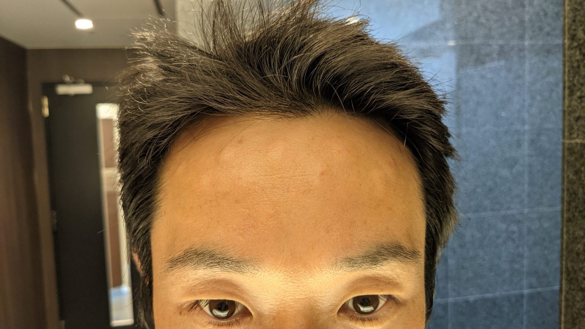 ボトックス注射直後の肌がボコボコになっている様子。