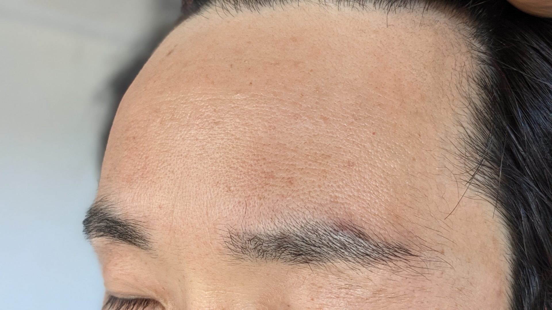 ボトックス注射1週間後のおでこの様子