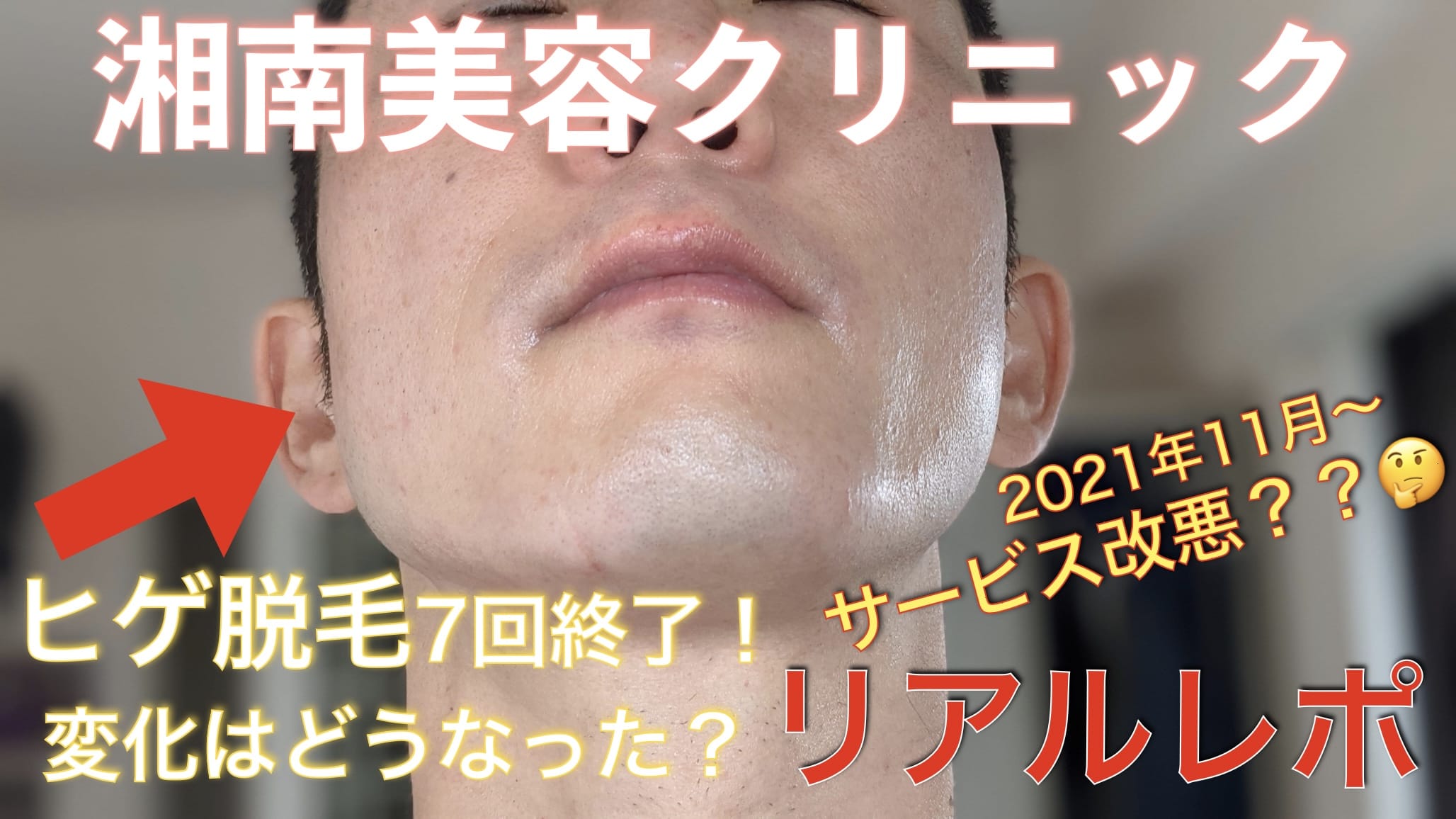 湘南美容クリニックのヒゲ脱毛7回目をやってきた経過写真がこちらサムネイル画像