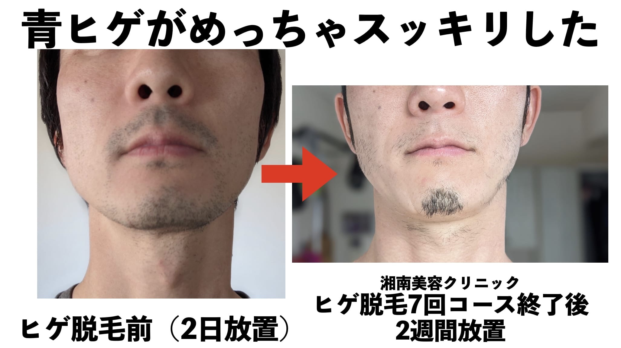 医療レーザーヒゲ脱毛7回目終わって2週間生やしっぱなしにした結果がこちらサムネイル画像