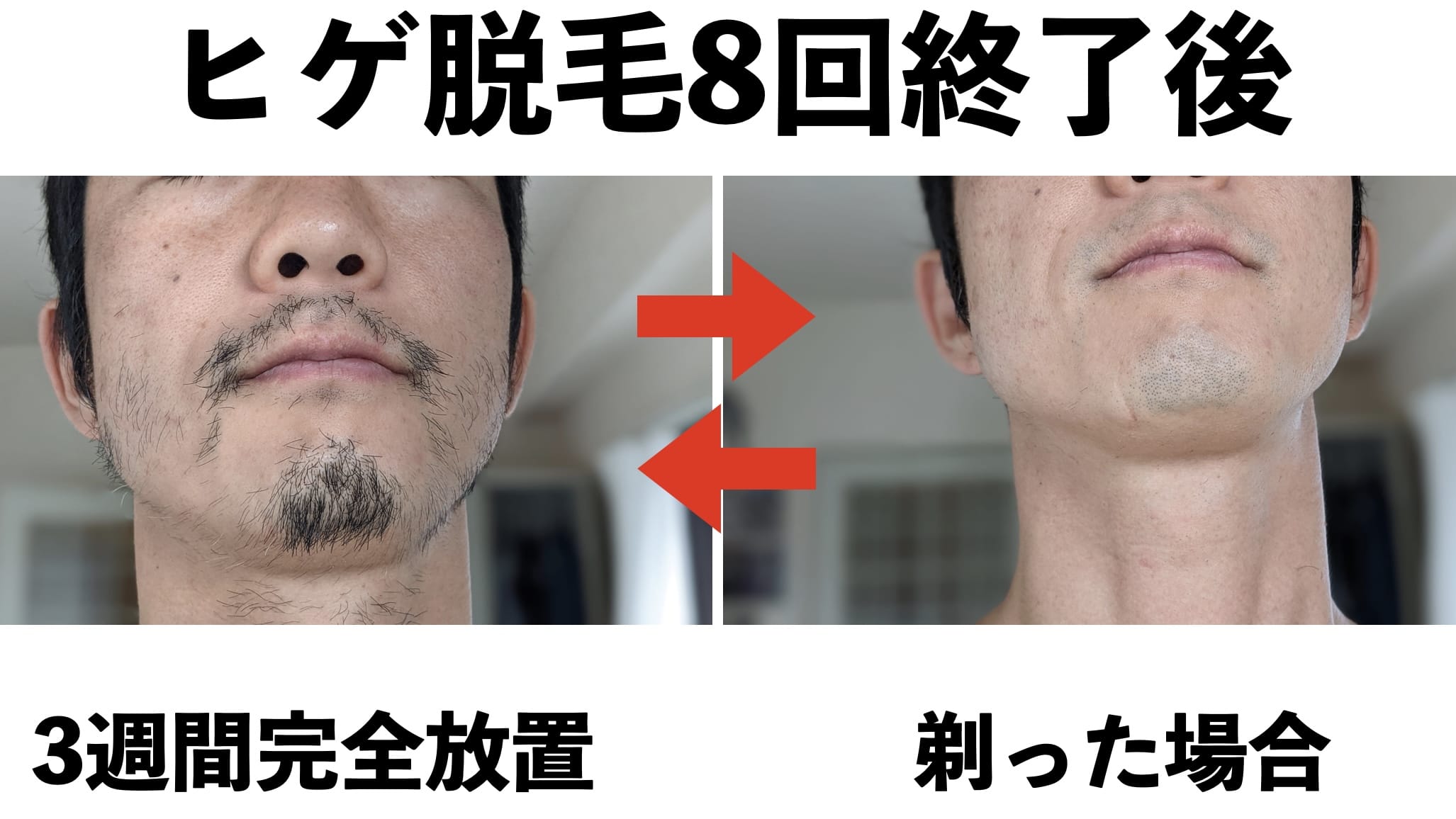ヒゲ脱毛の一番ちょうどいい回数は？僕は8回がベストでした。【ツルツルもヒゲスタイルも両方楽しめる】サムネイル画像