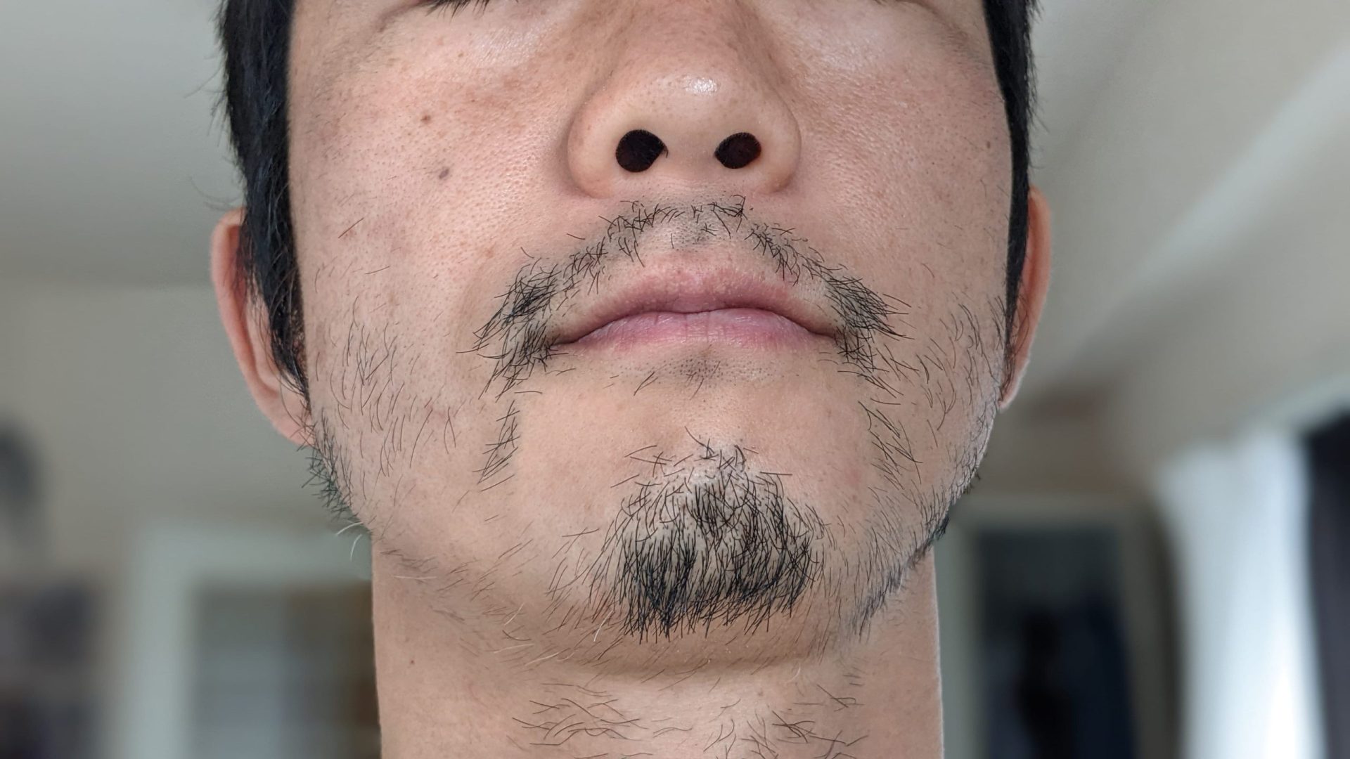 湘南美容クリニックの髭脱毛8回終了後：3週間ほどまったく何もせずに放置した場合