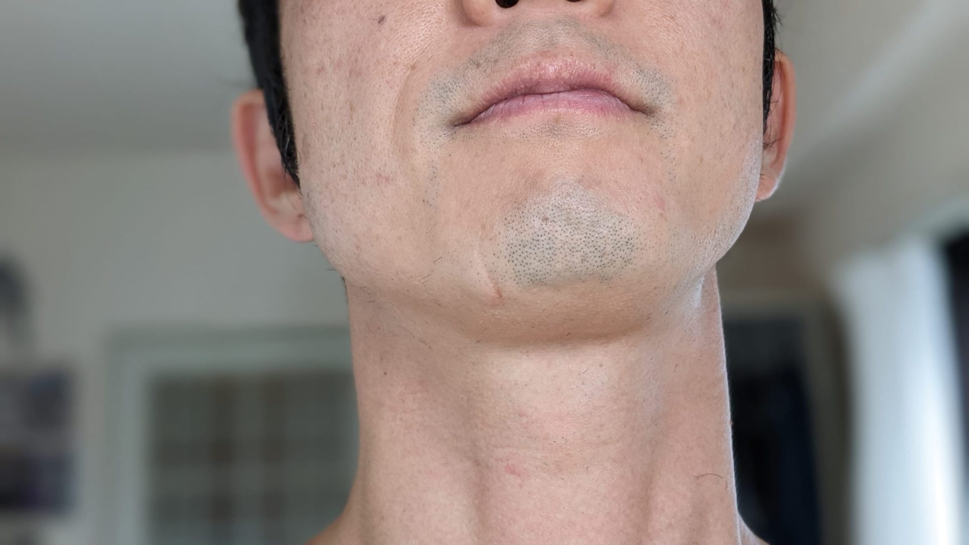 湘南美容クリニックの髭脱毛8回終了後：普通に剃った場合