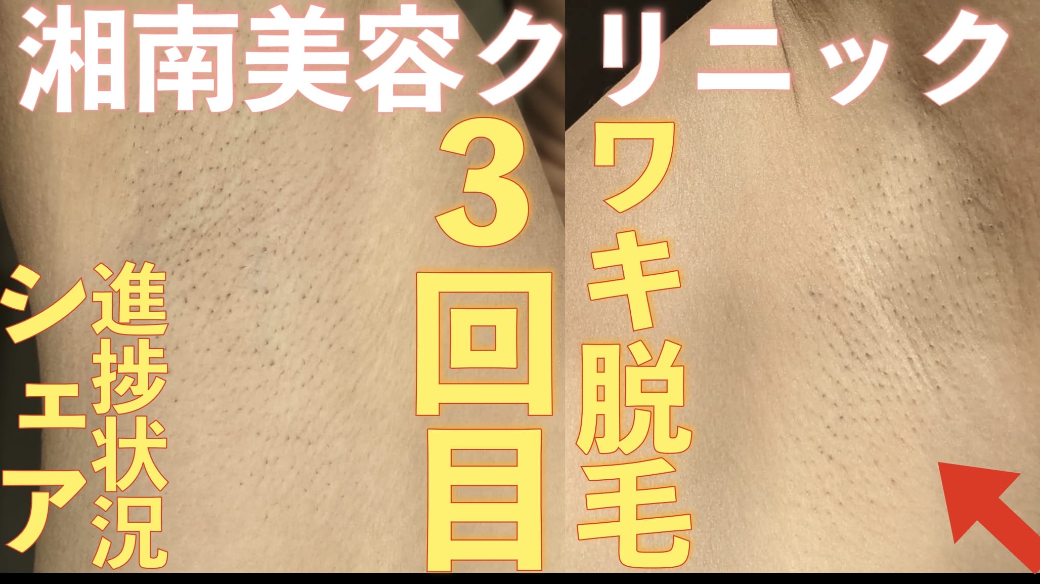 【写真あり】医療ワキ脱毛3回目やってきた。毛の状況シェア【湘南美容クリニック】