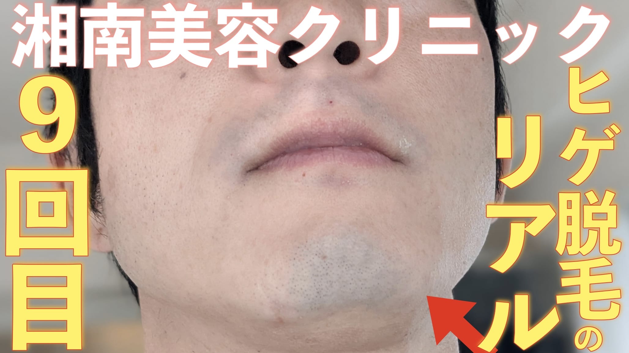 【写真あり】湘南美容クリニックでヒゲ脱毛9回目やってきました【定期報告】サムネイル画像
