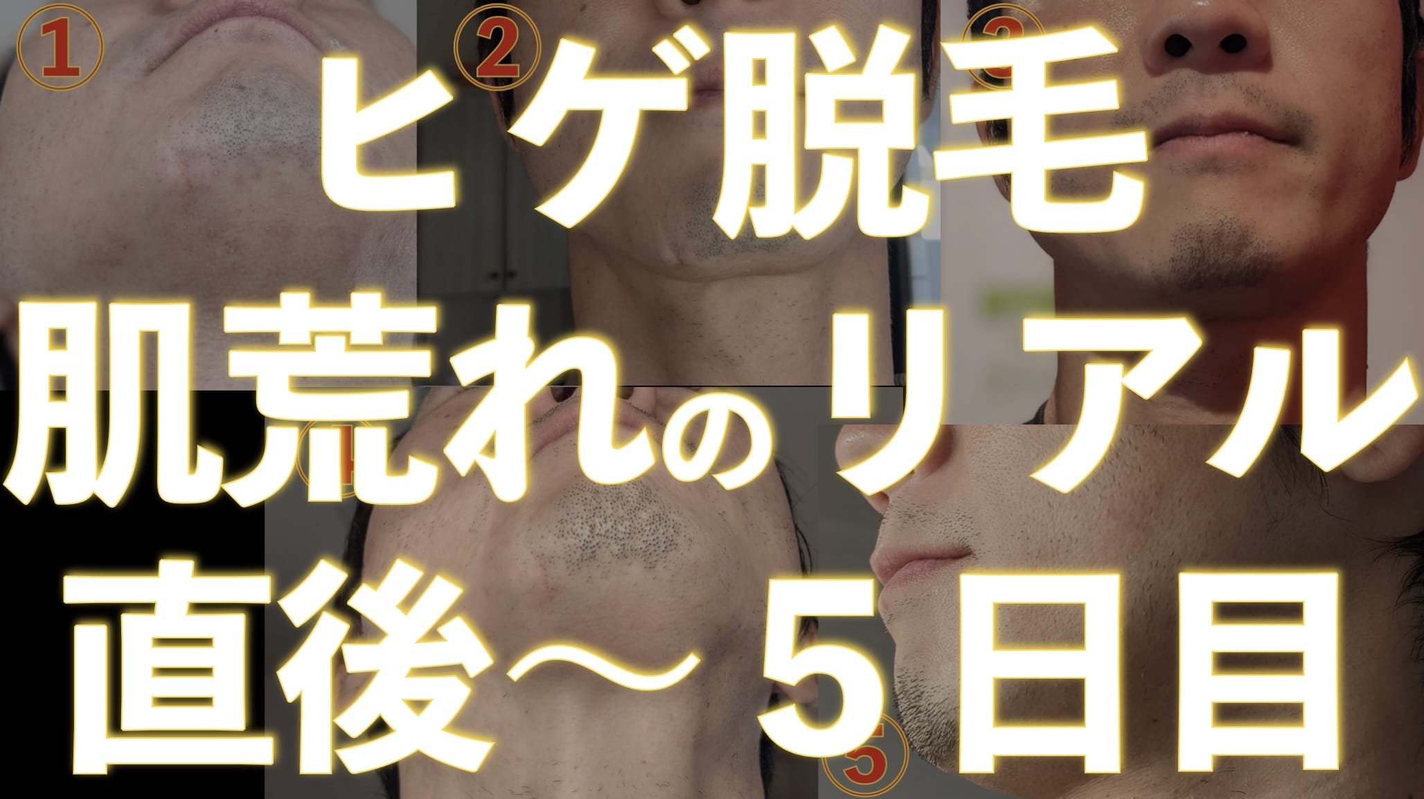 ヒゲ脱毛した後ってどのくらい肌荒れするの？【直後〜5日目まで写真で説明】サムネイル画像1