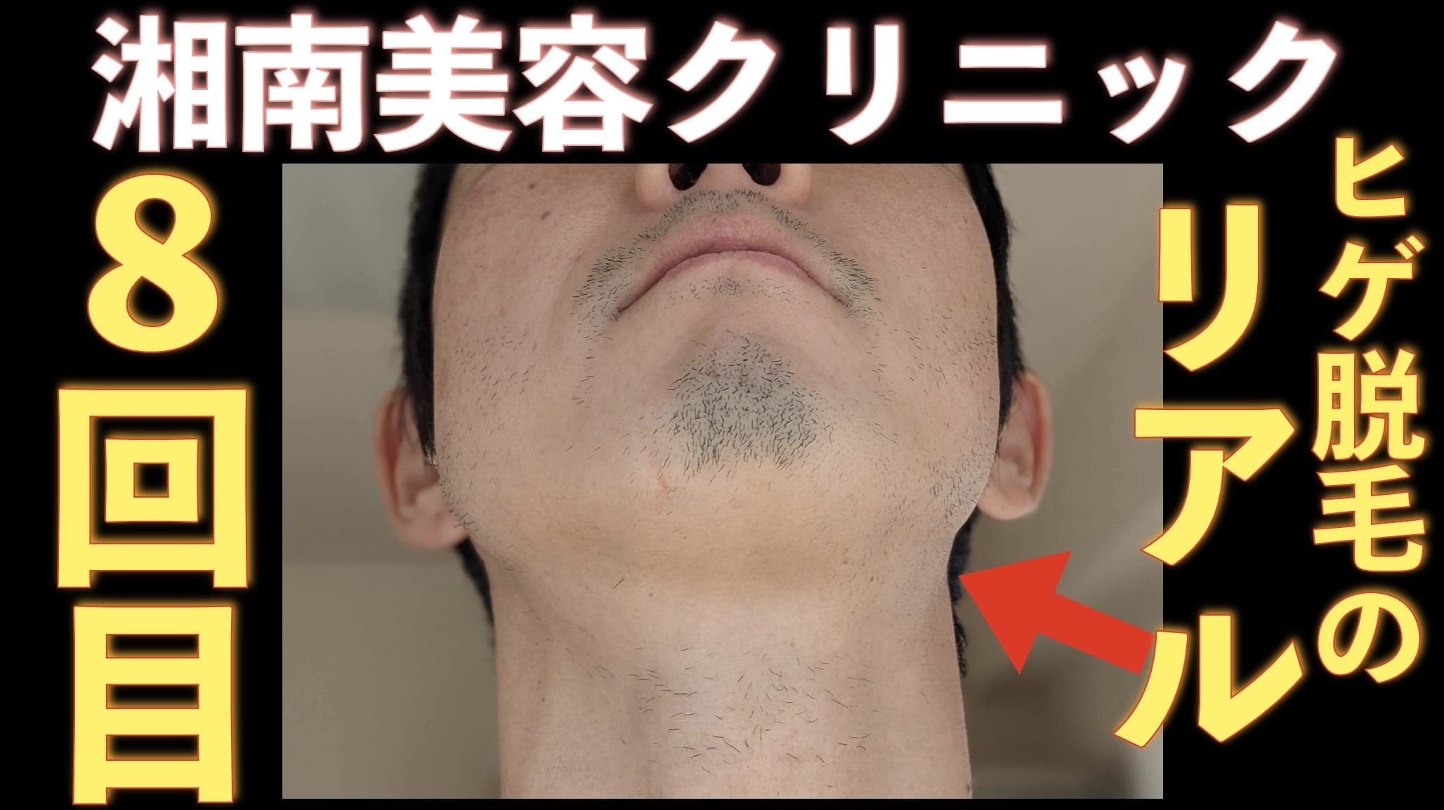 湘南美容クリニックでヒゲ脱毛8回目。1週間剃らずに放置した結果がこちら。