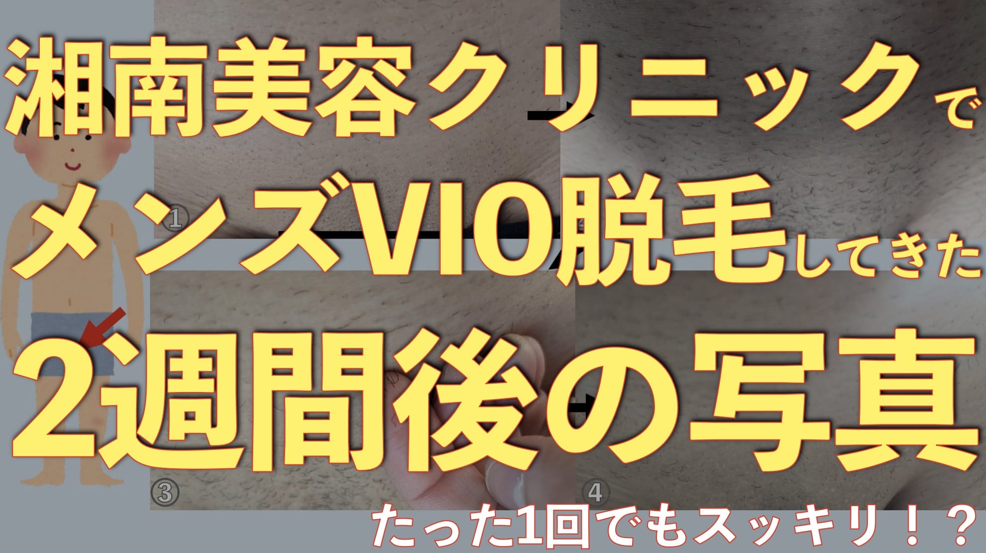 【一回でもスッキリ】メンズVIO医療レーザー脱毛後〜2週間までの変化を写真で紹介【湘南美容クリニック体験談】