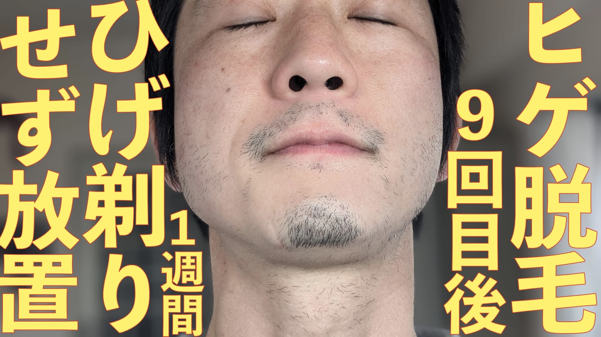 ヒゲ脱毛してから１週間ひげ剃りしないとこのくらい生えてきます【9回目@湘南美容クリニック】サムネイル画像