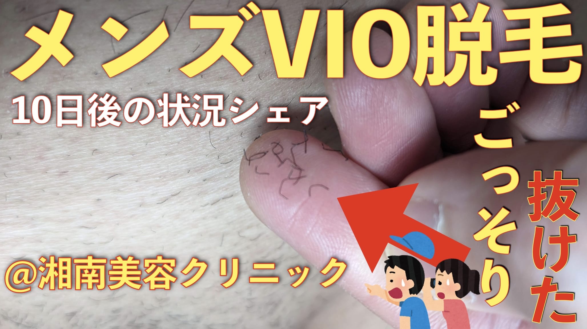 メンズVIO医療レーザー脱毛して10日後、ポロポロと毛が大量に抜けはじめた様子【湘南美容クリニック】サムネイル画像