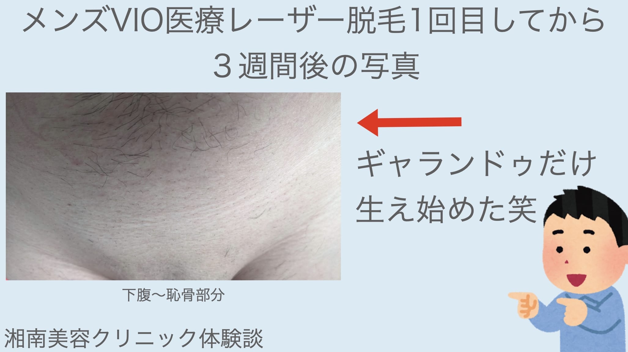 湘南美容クリニックではじめてのメンズVIO脱毛から３週間経過の写真【ギャランドゥだけ生え始めた笑】サムネイル画像