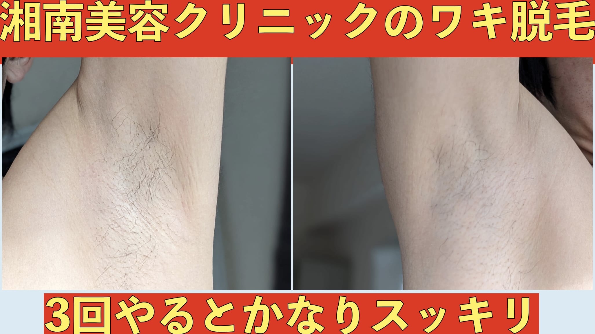 湘南美容クリニックのワキ脱毛。3回やるとかなりスッキリ