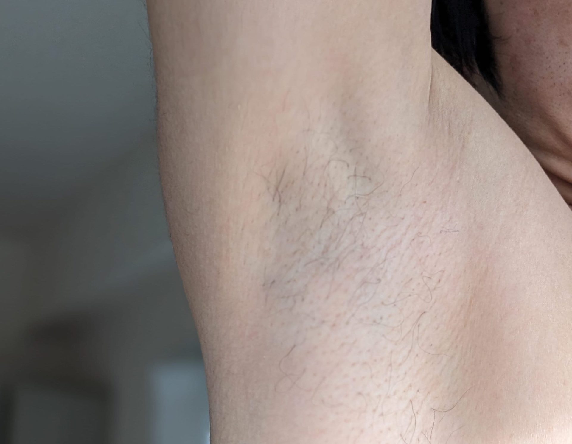 湘南美容クリニックで脱毛3回目完了してから1ヶ月放置した右脇