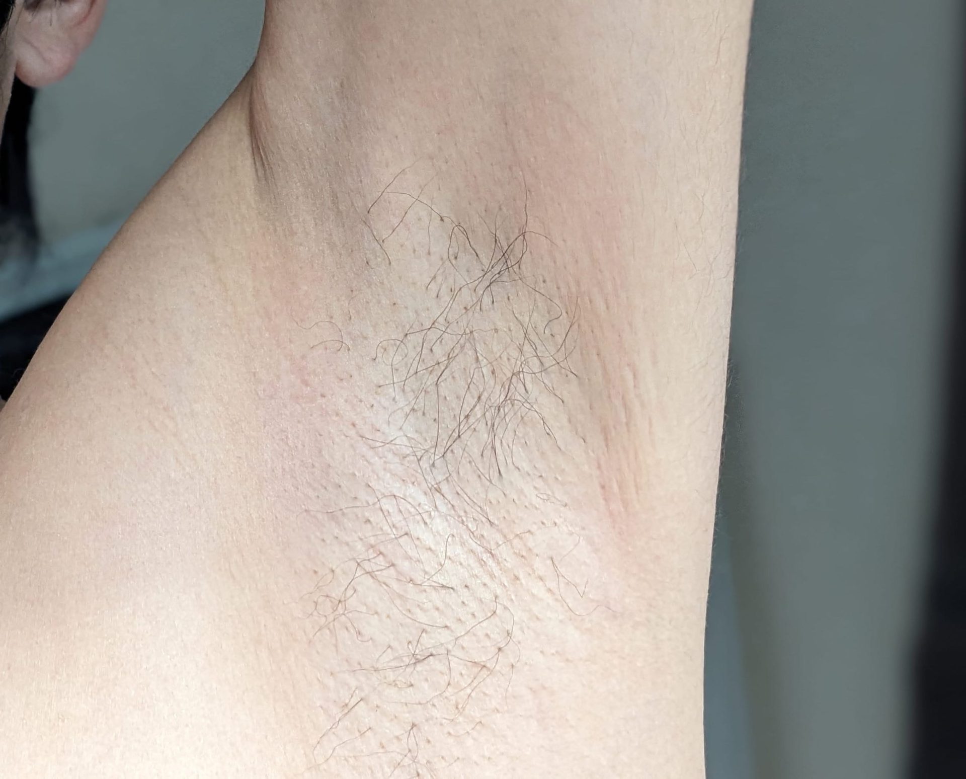 湘南美容クリニックで脱毛3回目完了してから1ヶ月放置した左脇の写真