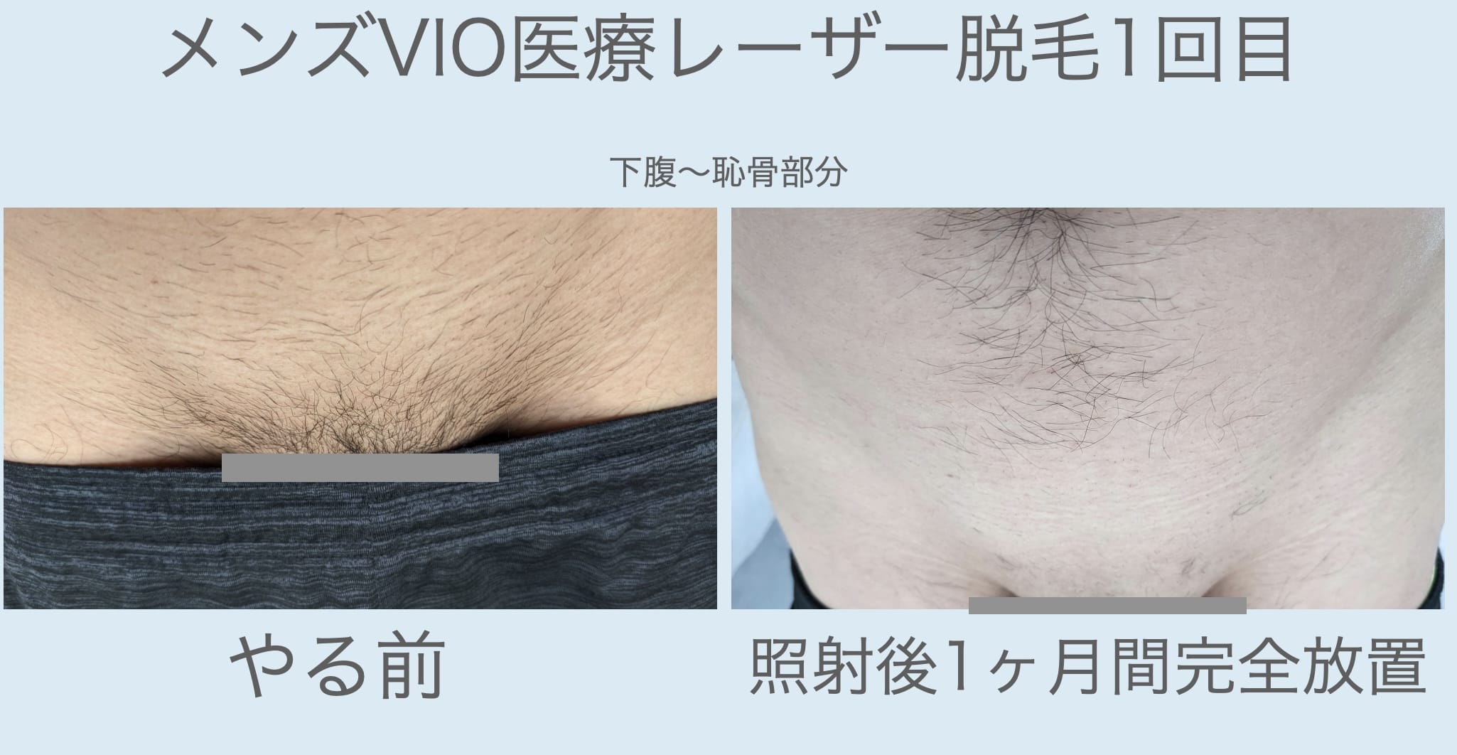 メンズVIO医療レーザー脱毛1回目してから1ヶ月後の写真（やる前と比較）