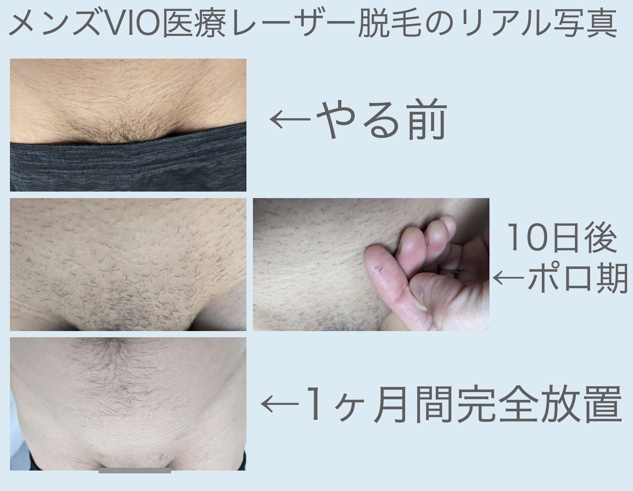 メンズVIO医療レーザー脱毛1回目してから1ヶ月後の写真（ポロ期などの流れ）