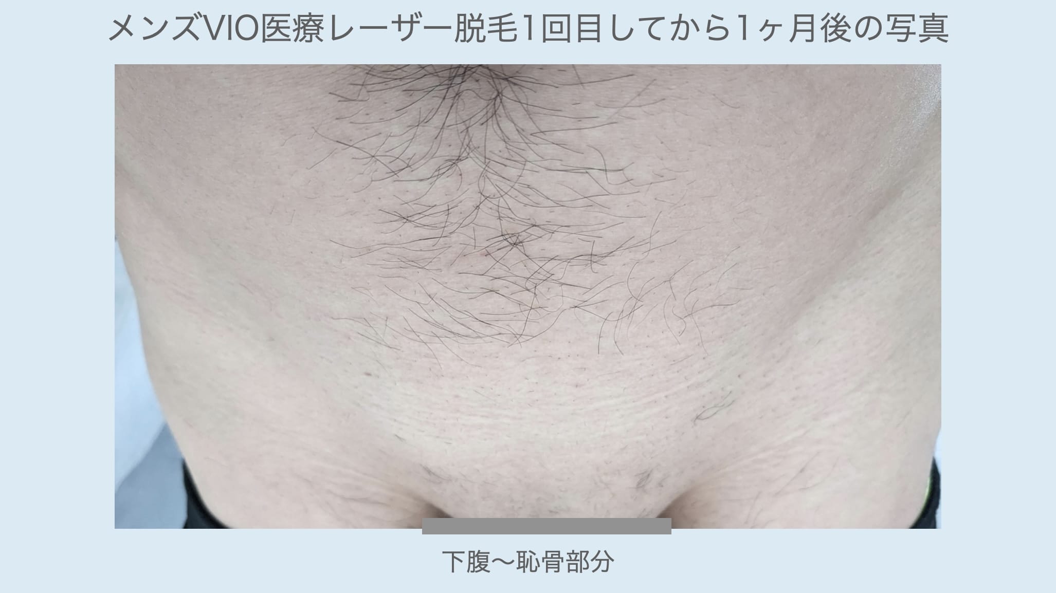 メンズVIO医療レーザー脱毛1回目してから1ヶ月後の写真