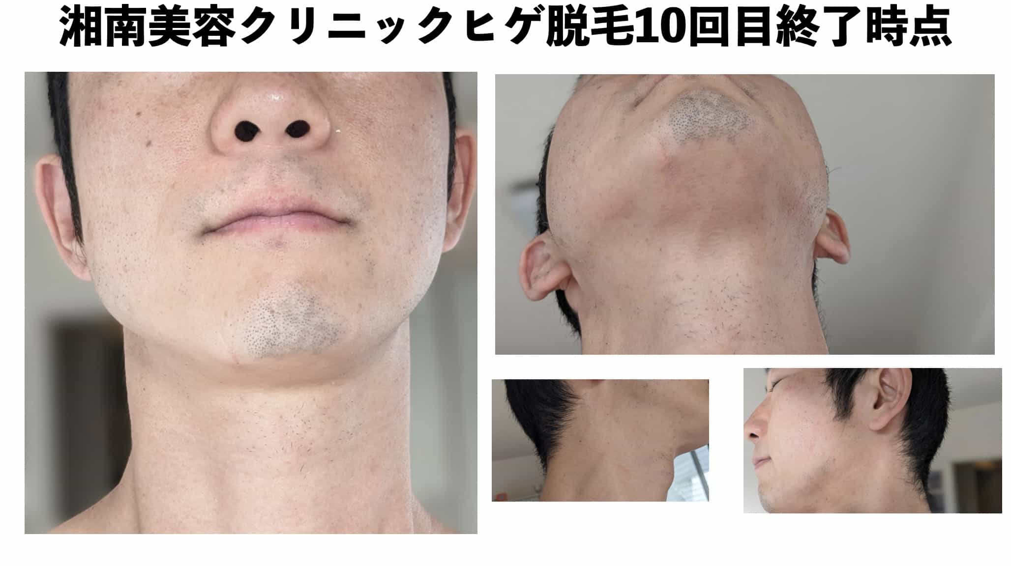 湘南美容クリニックヒゲ脱毛10回目終了時点