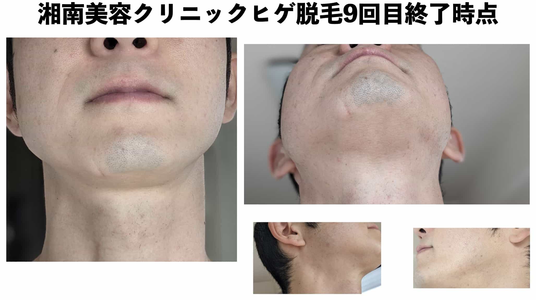 湘南美容クリニックヒゲ脱毛9回目終了時点