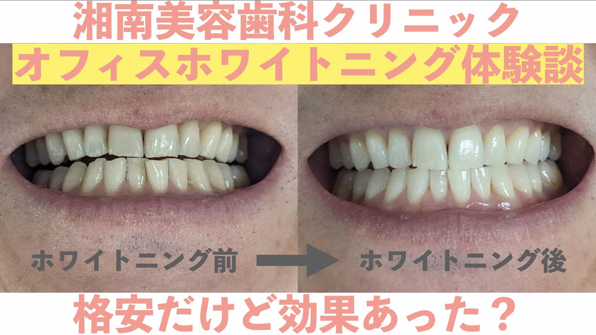 【体験談】湘南美容クリニック歯科でオフィスホワイトニングしてきた【格安だけど効果ある？】