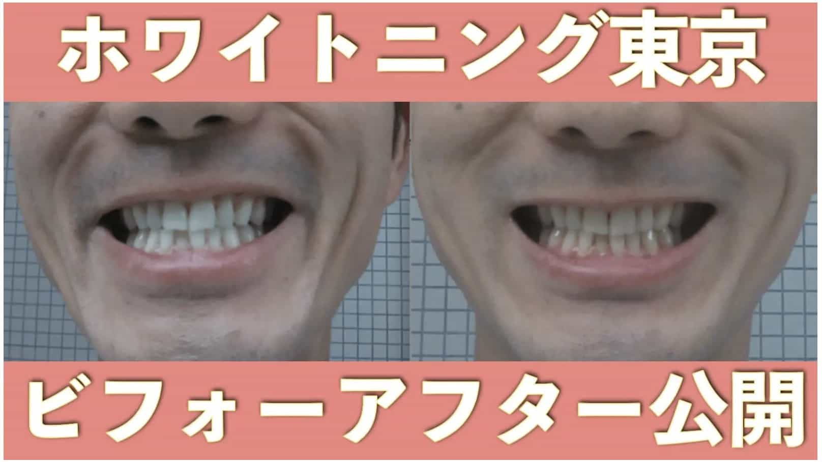 ホワイトニング東京オフィスホワイトニングビフォーアフター画像