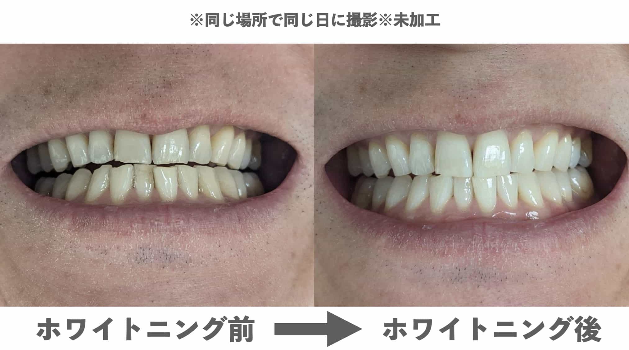 湘南美容歯科クリニックでオフィスホワイトニングした結果