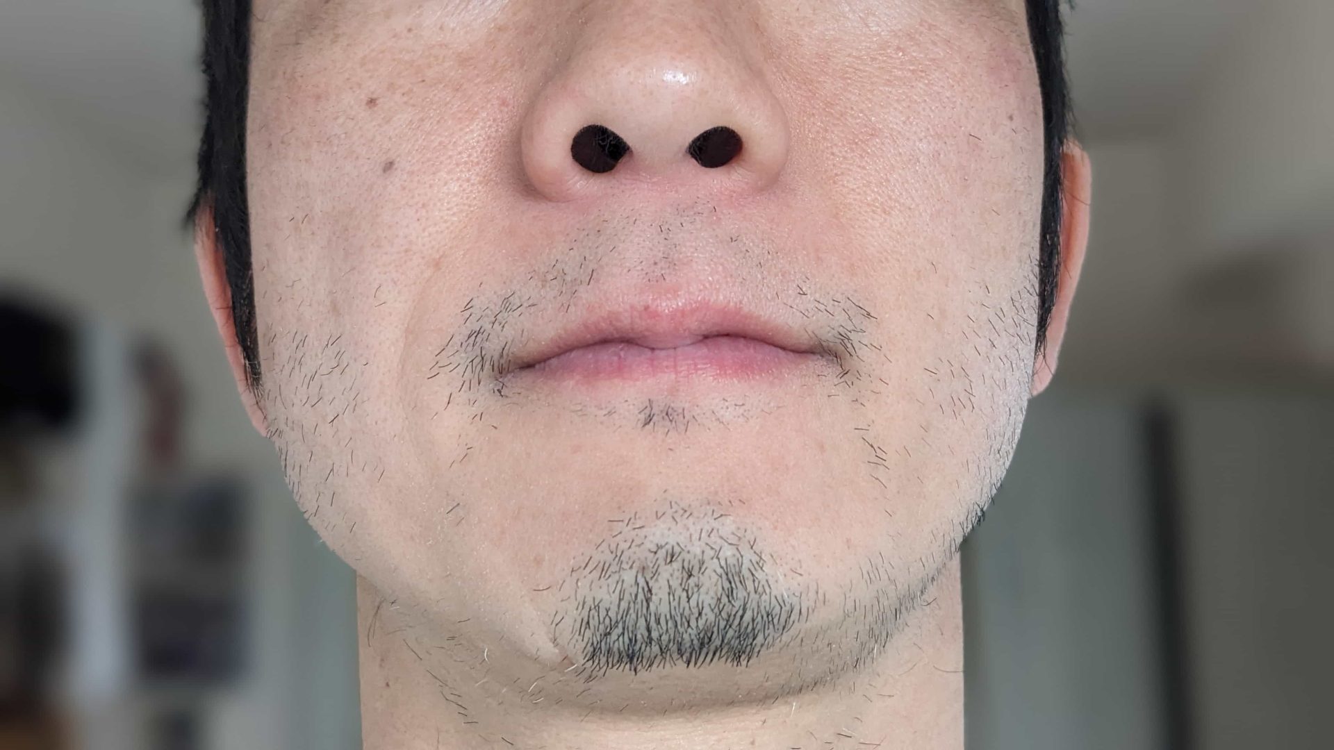 湘南美容クリニックでヒゲ脱毛10回目終了後の写真。アゴ・頬・もみあげ・首のけが気になる