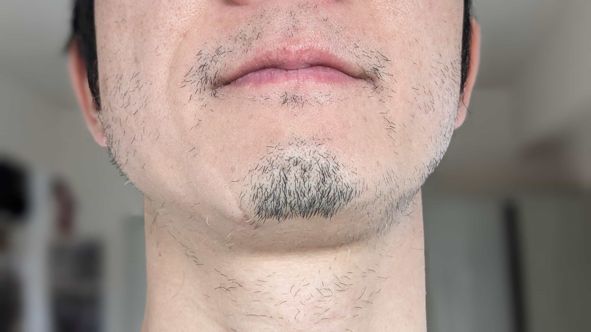 湘南美容クリニックでヒゲ脱毛10回目終了後の写真。アゴ・頬・もみあげ・首のけが気になる