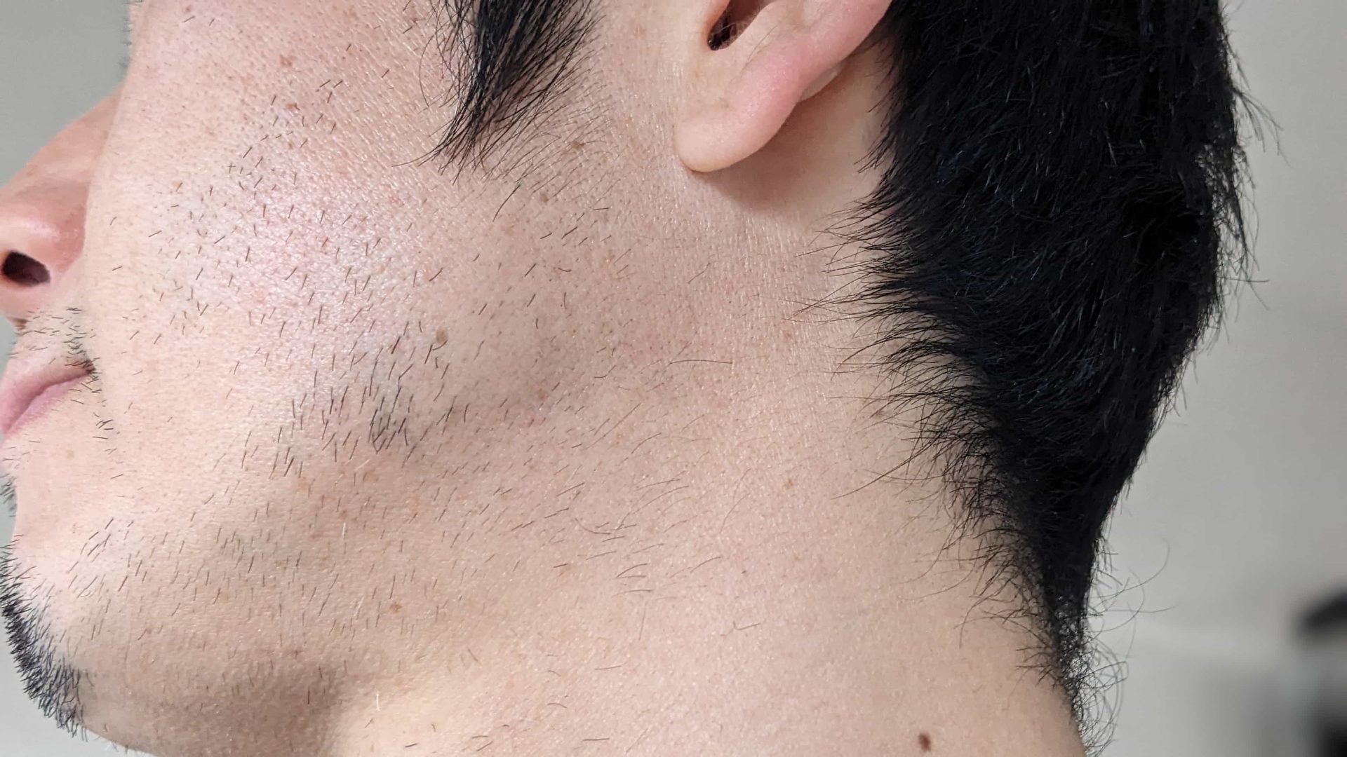 湘南美容クリニックでヒゲ脱毛10回目終了後の写真。アゴ・頬・もみあげ・首のけが気になる