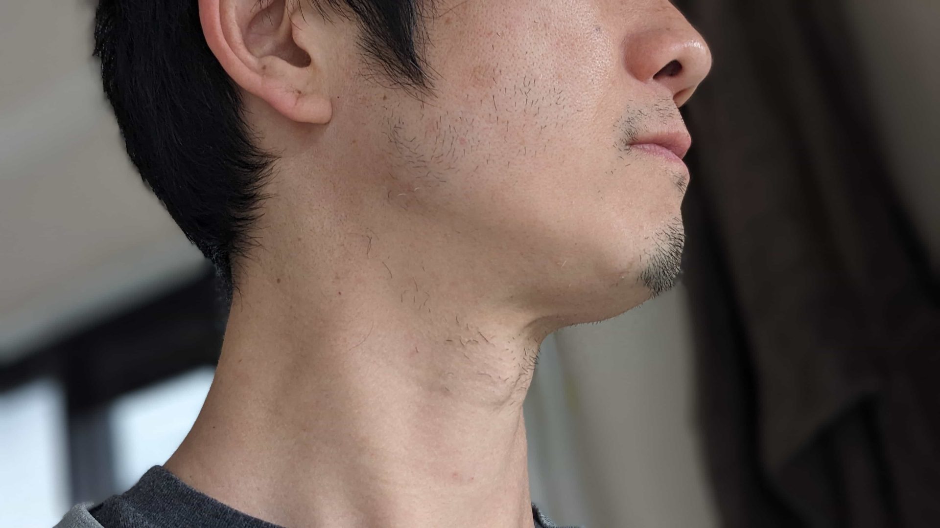 湘南美容クリニックでヒゲ脱毛10回目終了後の写真。アゴ・頬・もみあげ・首の毛が気になる