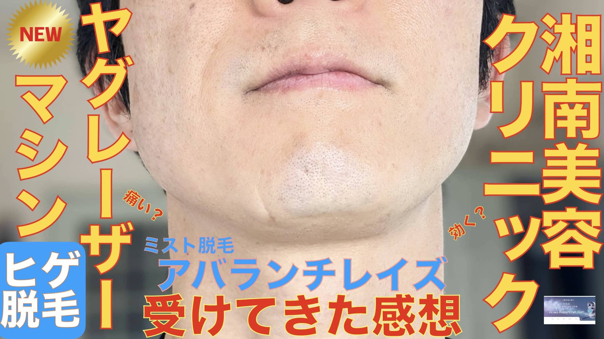 【激痛？麻酔いる？】湘南美容クリニックの新型YAGレーザー「アバランチレイズ」を受けてきた。感想を語るサムネイル画像