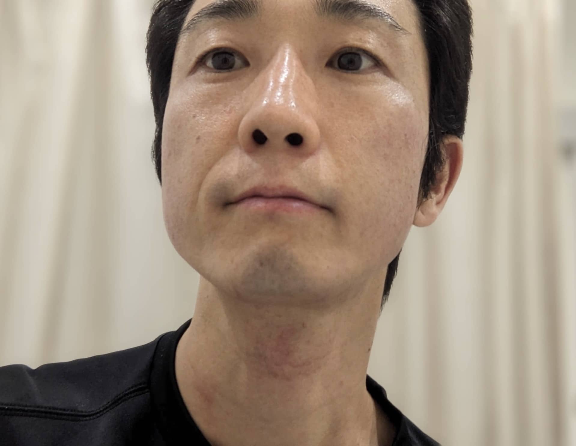 アバランチレイズ受けた直後の肌の腫れの様子