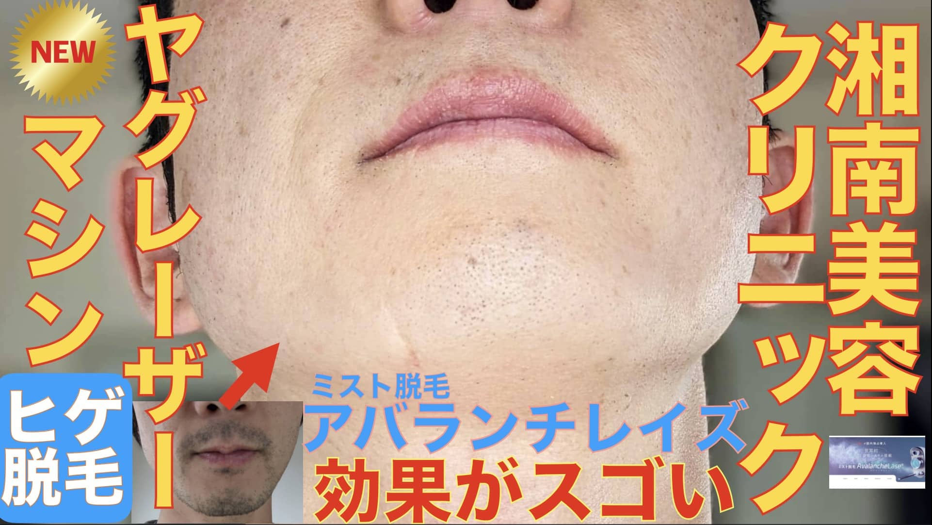 【検証レポート】湘南美容クリニックの新機種ヤグレーザー搭載アバランチレイズのヒゲ脱毛効果サムネイル画像