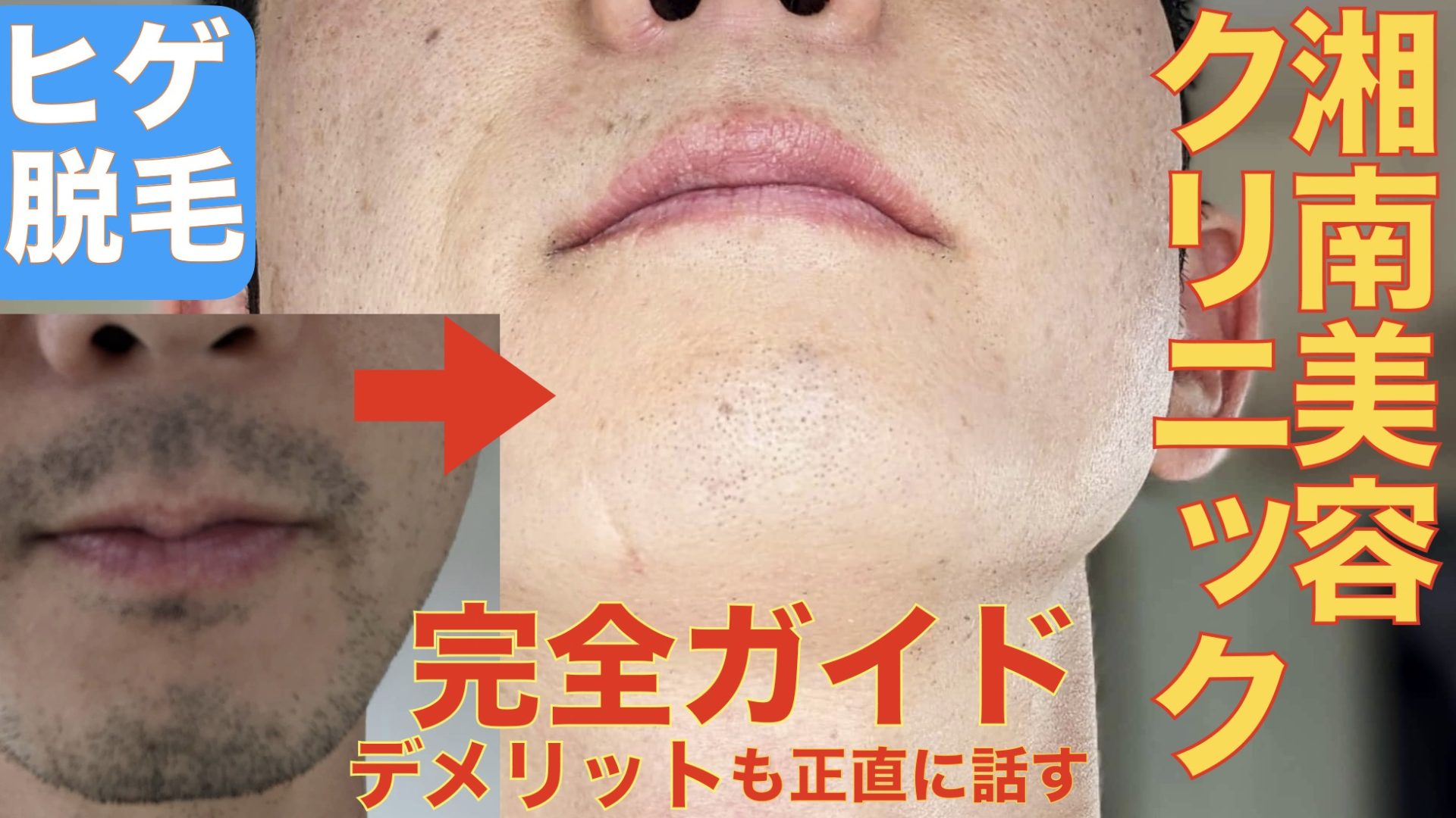 当ブログにようこそ！湘南美容クリニックのヒゲ脱毛予約方法やお得なクーポン情報サムネ1