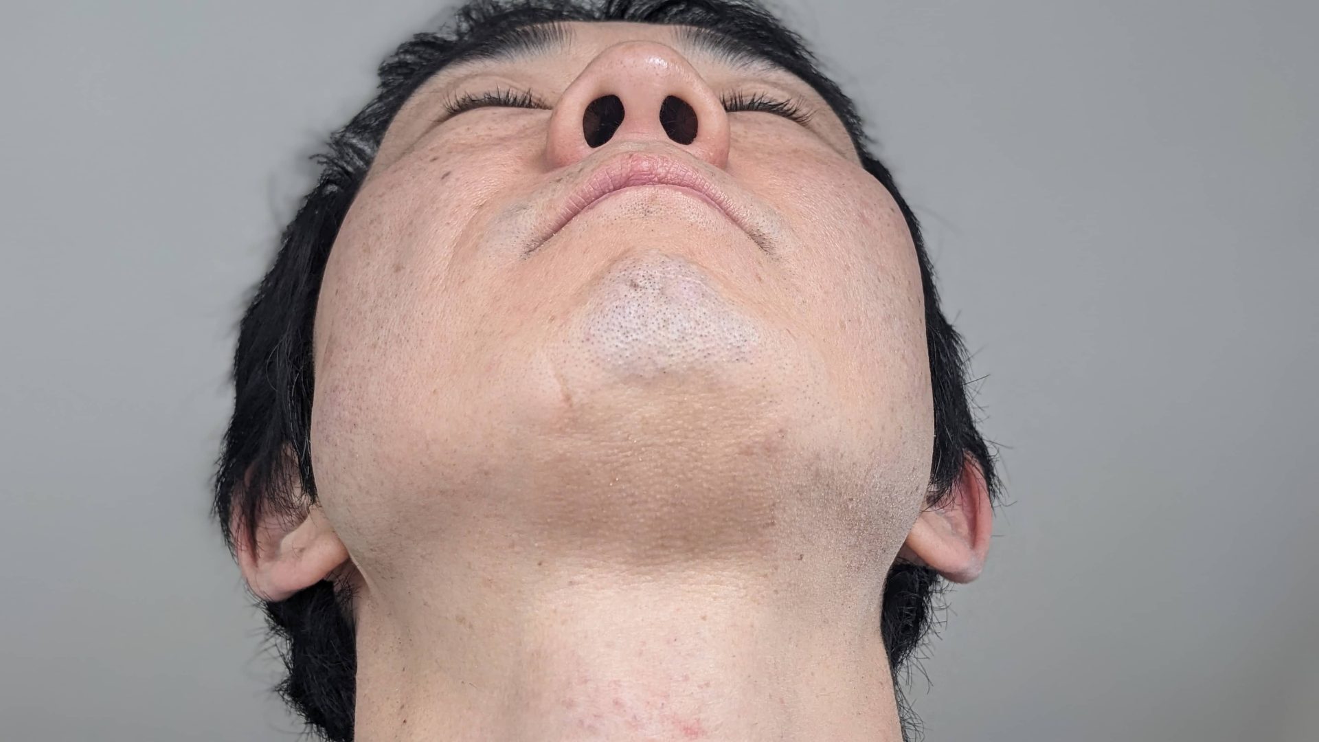 アバランチレイズ受けてから2時間くらい経過した後の写真。赤みや腫れも割とすぐに引いたけど、火照った感じは翌日まで続いた。