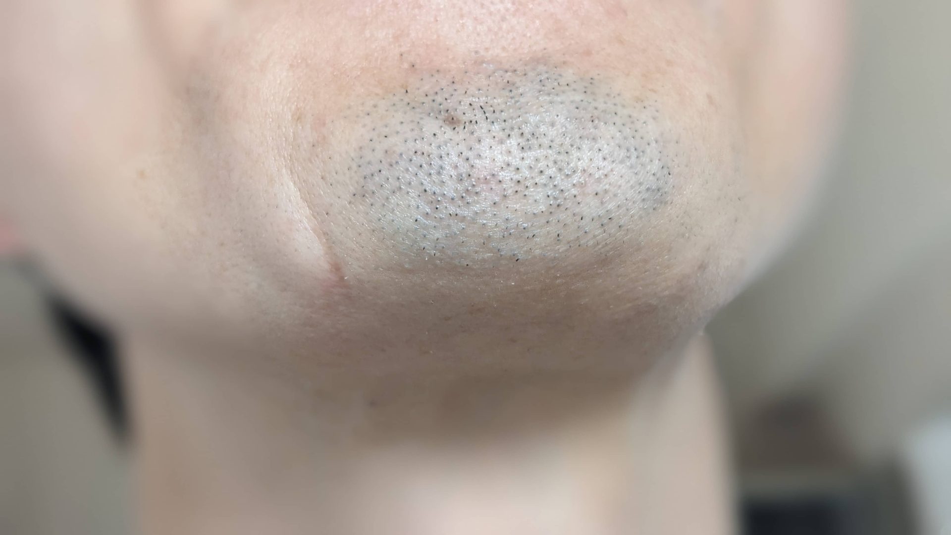 アバランチレイズ打って2時間後くらい。アゴの毛穴がぷっくりしてきてる。経験上、こうなるとよく抜けてくれることが多い。