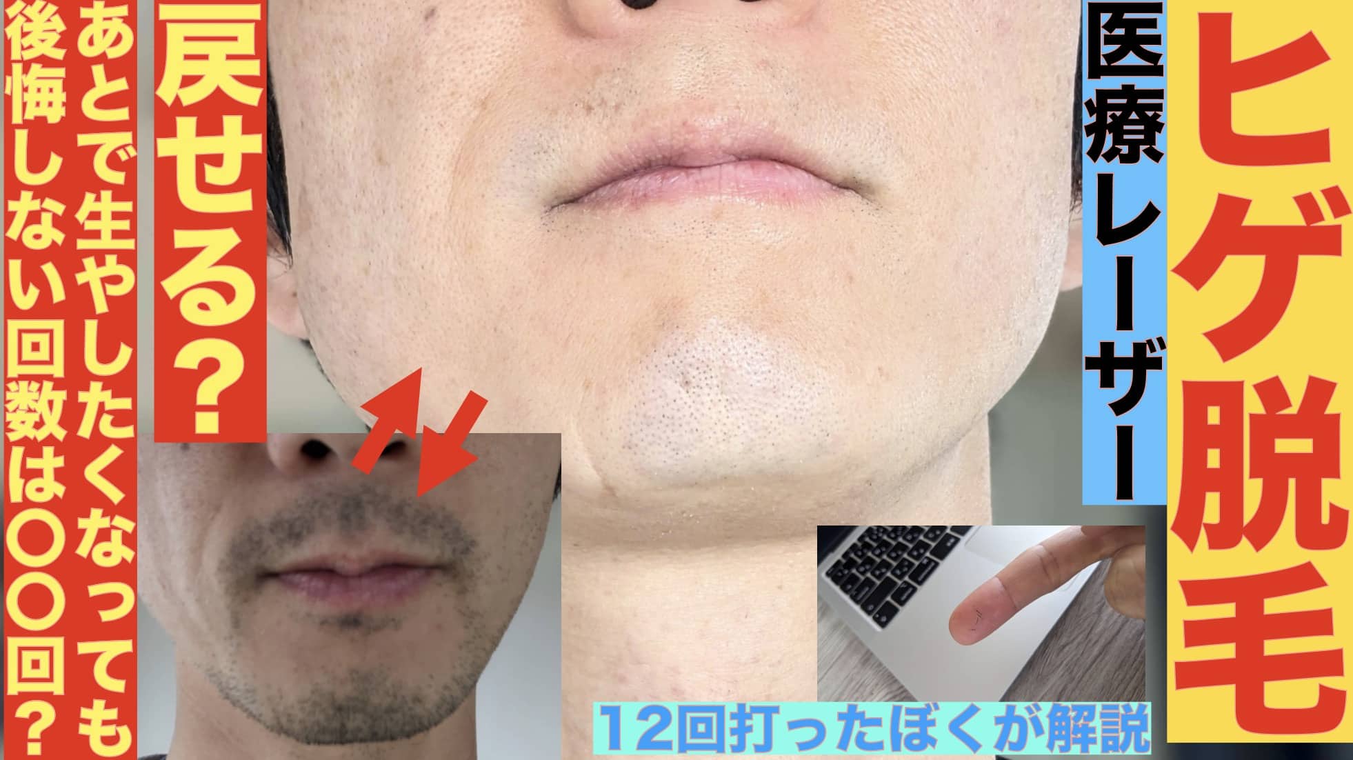 【ヒゲ脱毛】あとで生やしたくなったらどうする？「〇回でやめとけば将来後悔しなくて済むかも」経験者談サムネイル画像