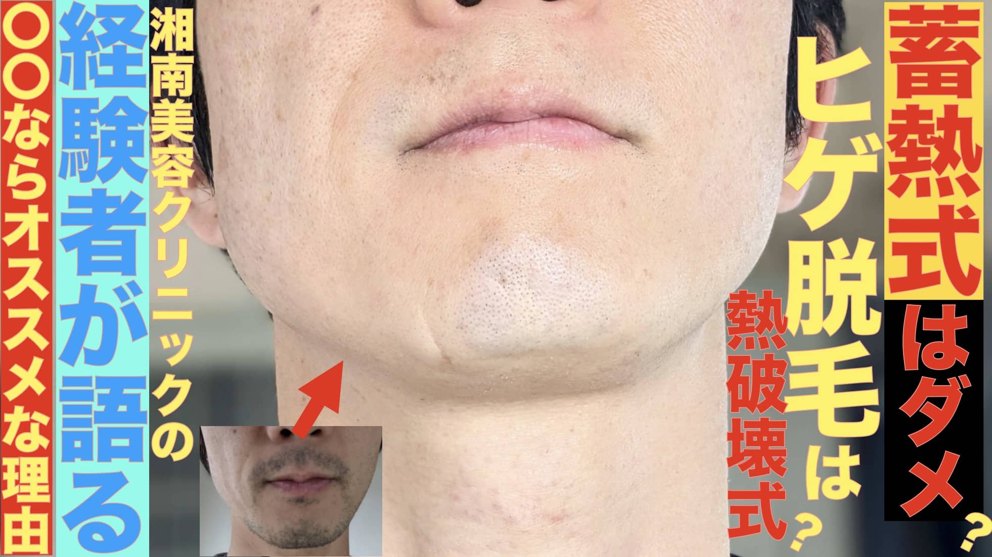 【ヒゲ脱毛】蓄熱式は効果ない？経験者が解説！湘南美容クリニックなら熱破壊式マシンの指定予約が可能サムネイル画像